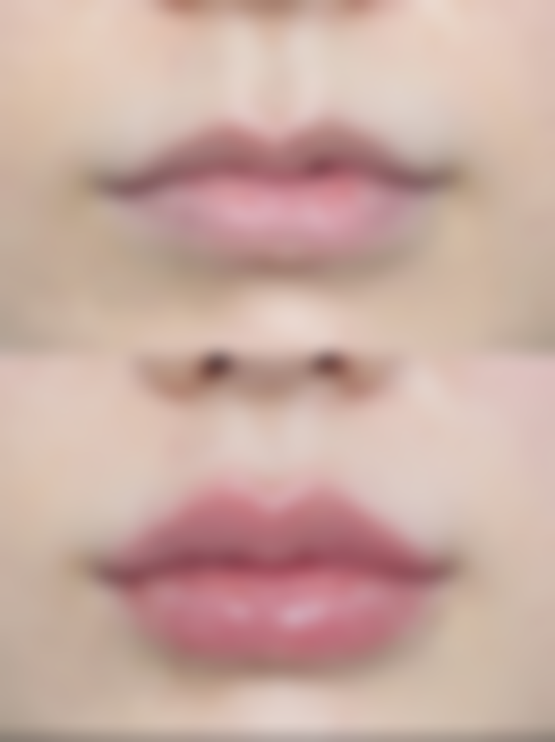 如何判断骨性还是牙性凸嘴？