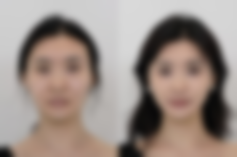 嘴向外凸怎么矫正？揭秘医美界3大有效矫正方案，助你轻松拥有自然美观的脸型！ 