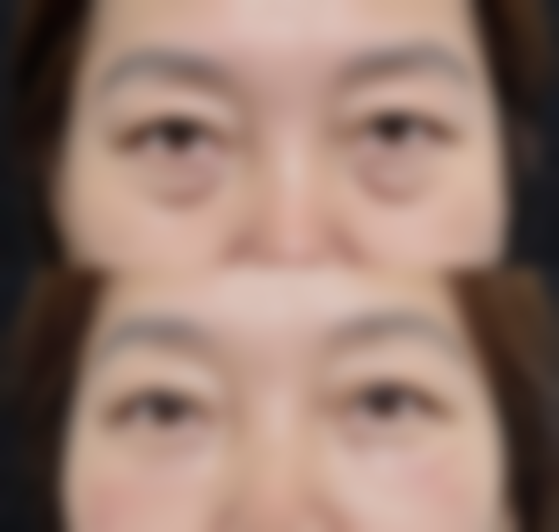 植发后的长期维护