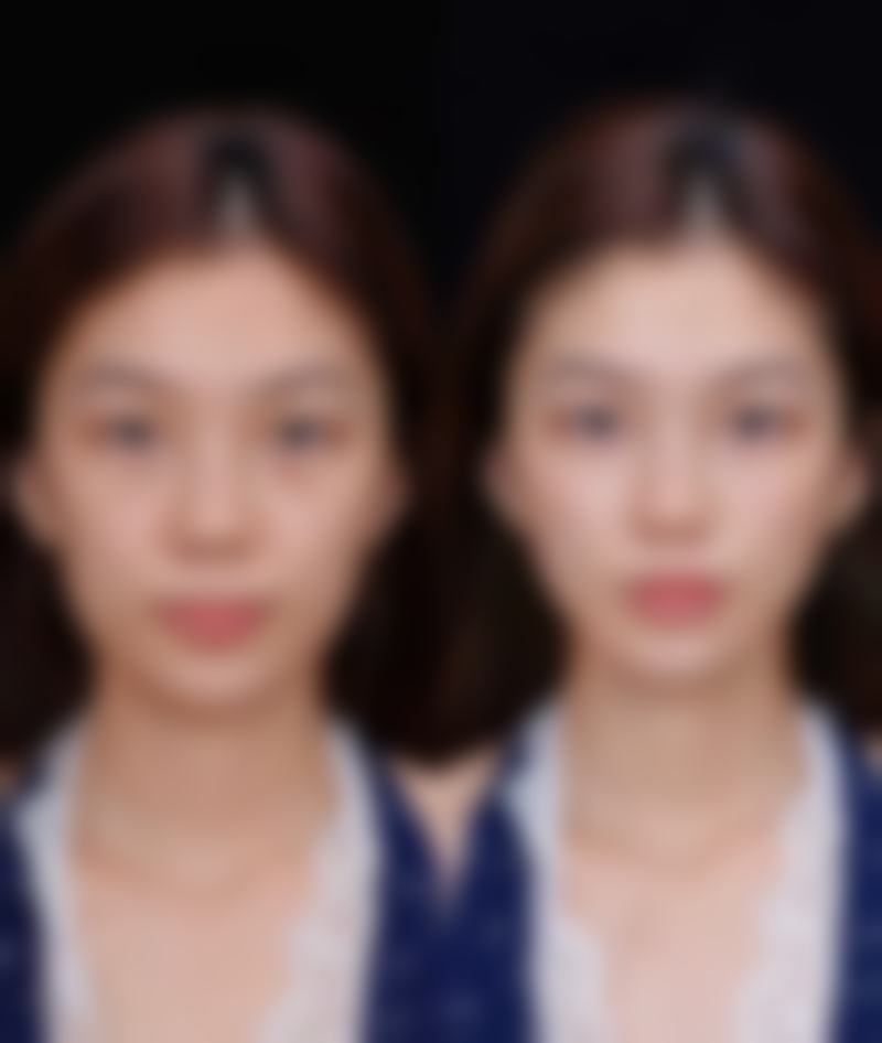 除皱针后脸僵硬怎么办