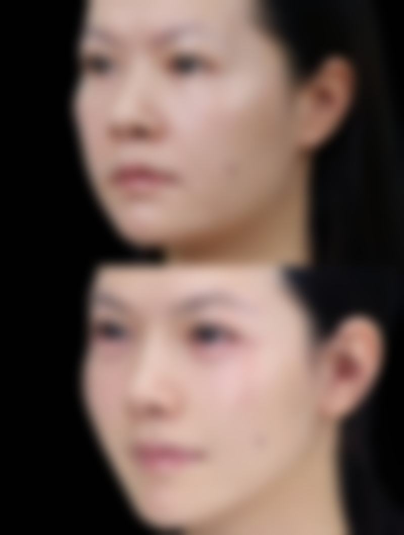 颧骨内推和磨颧骨的区别