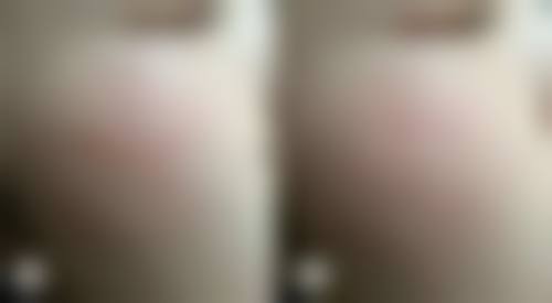 打除皱针前可以化妆吗