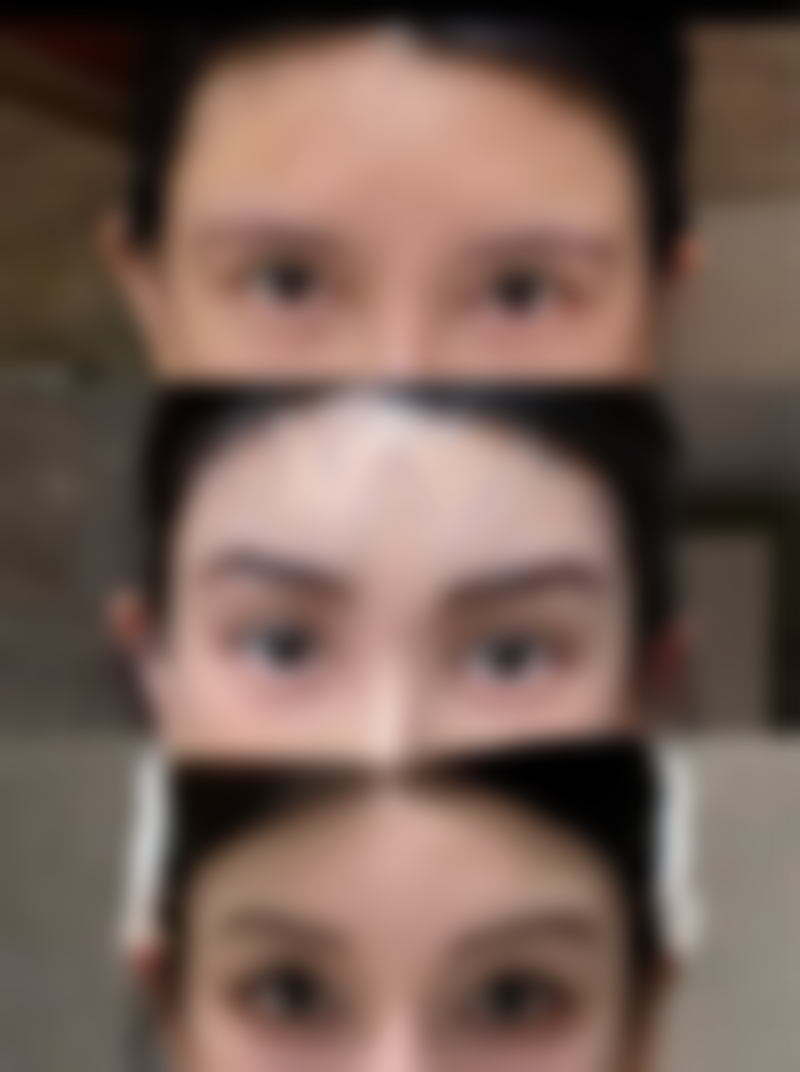 打除皱针多久能洗脸