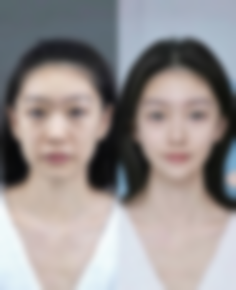 韩国大熊瘦脸针怎么样？揭秘其3大显著优势，效果持久自然，助你轻松拥有精致小脸！ 