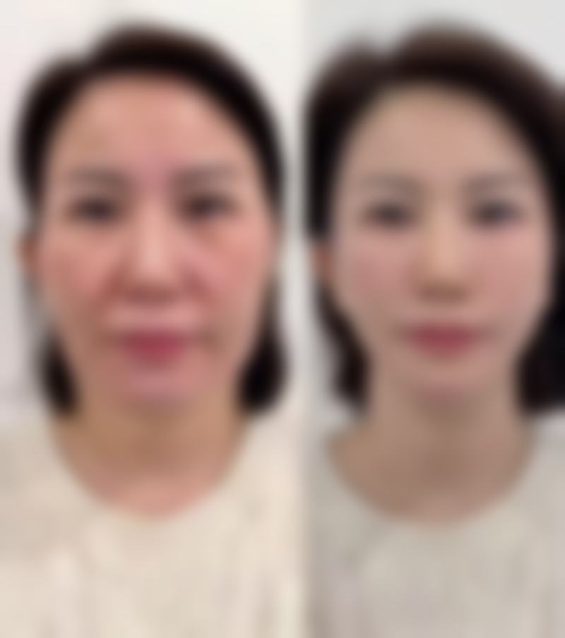 六、美白针会反弹变黑吗