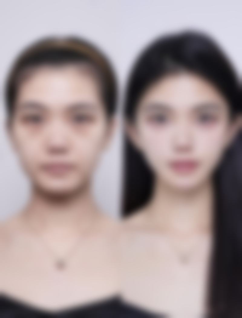 注射瘦脸针管用吗