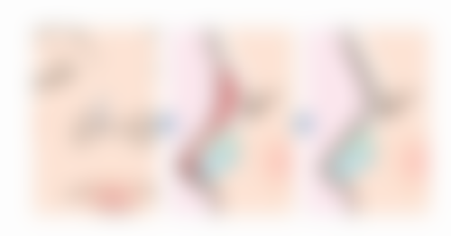 保妥适除皱针的危害和副作用