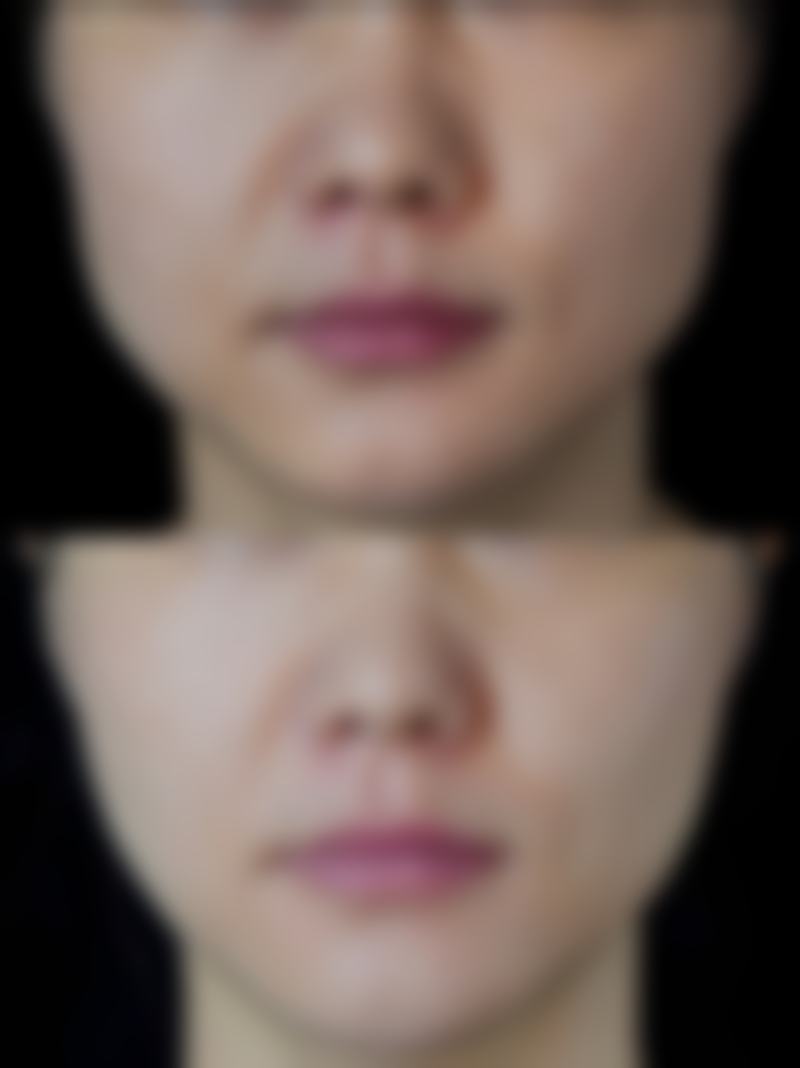 瘦脸针的美学适配性