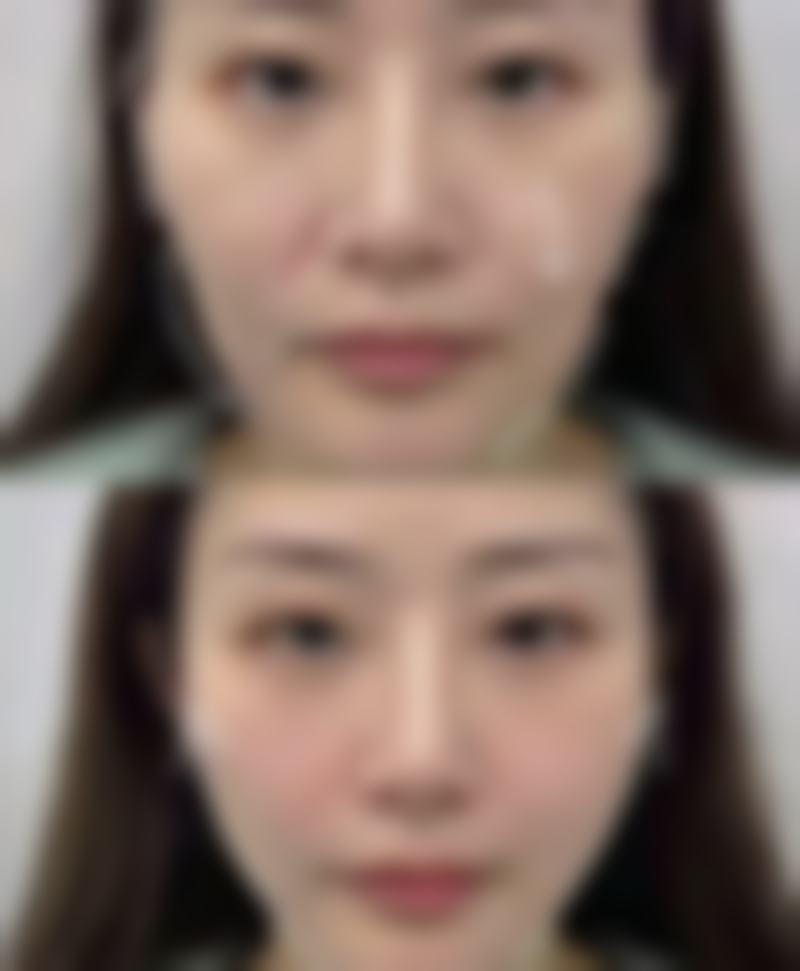 保妥适除皱针有效吗？权威数据揭示其高达90%有效率，快速抚平皱纹，让你年轻10岁不是梦！ 