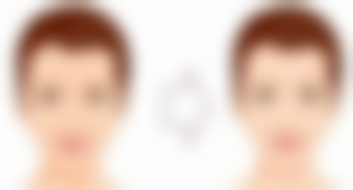 毛发种植一般需要多少钱贵不贵