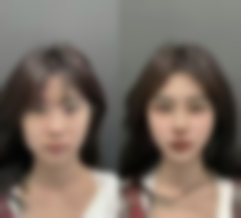 怎么样才可以下巴整形？了解这5种常见医美方法，让你轻松拥有精致下巴不再是梦！ 