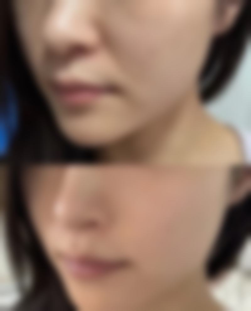 毛发种植后多久可以洗头