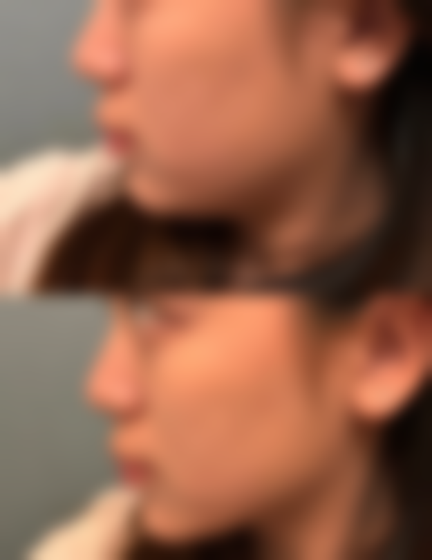 怎么能让下巴变好看