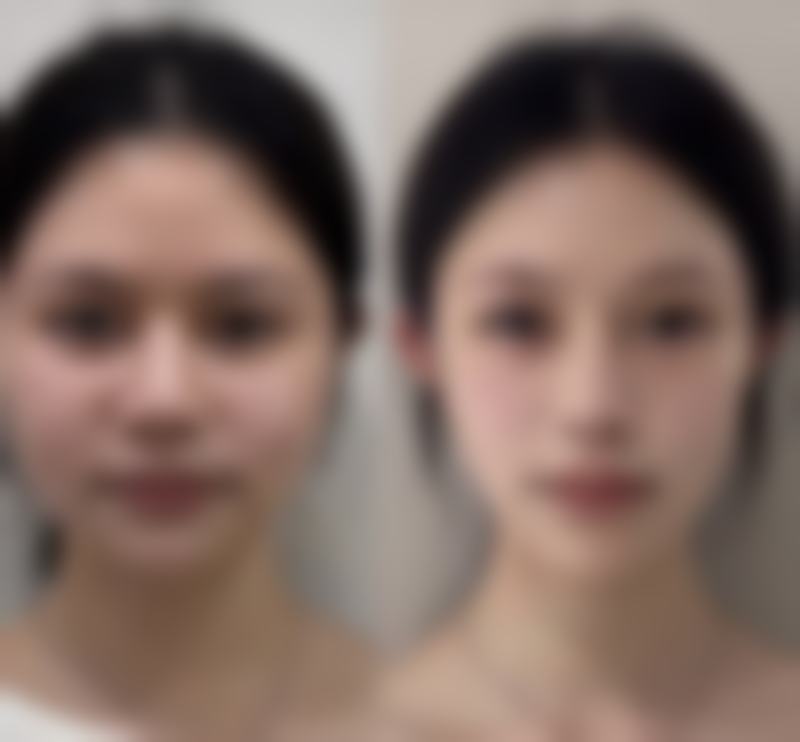 除皱针打多了的副作用