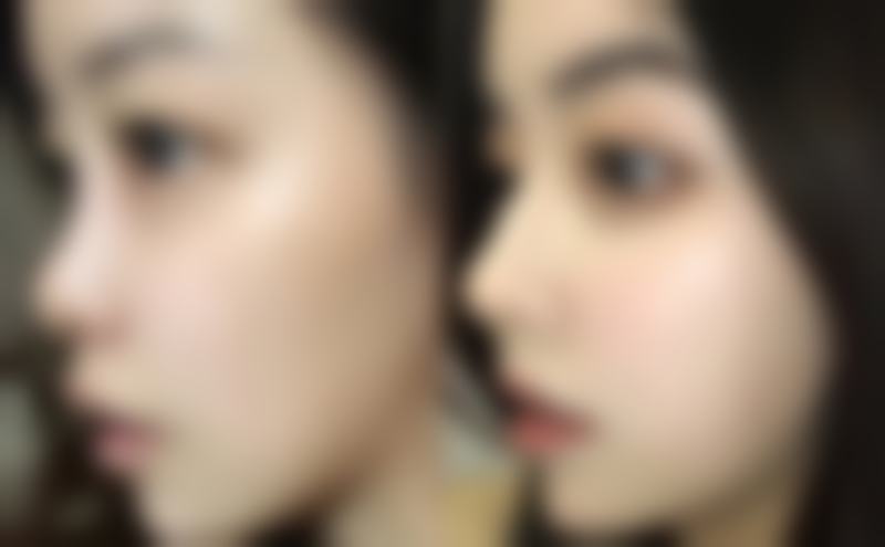 一支瘦脸针的剂量