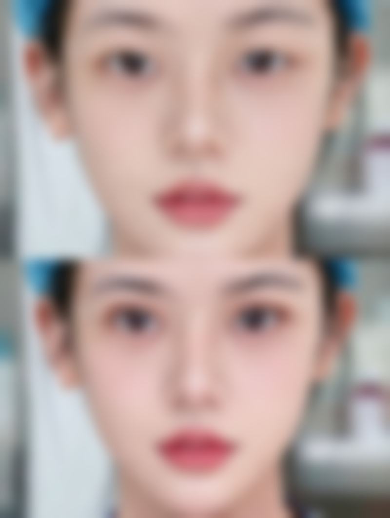 打除皱针对脸有伤害吗