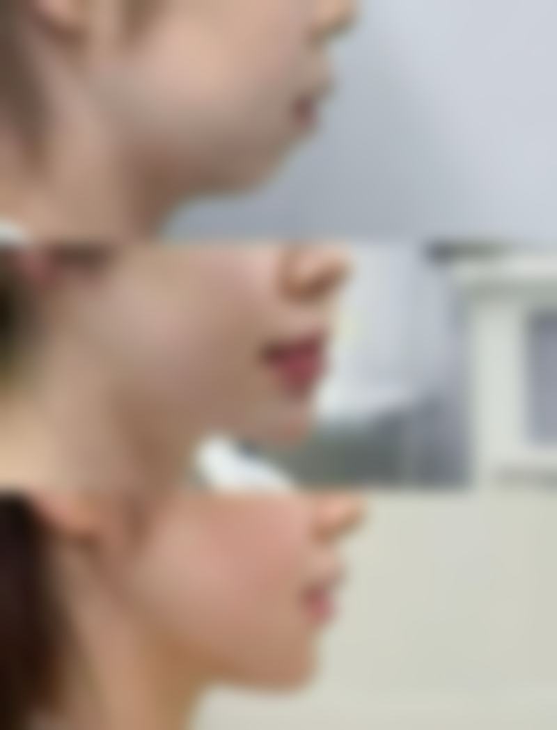 除皱针打咬肌的副作用及应对方法