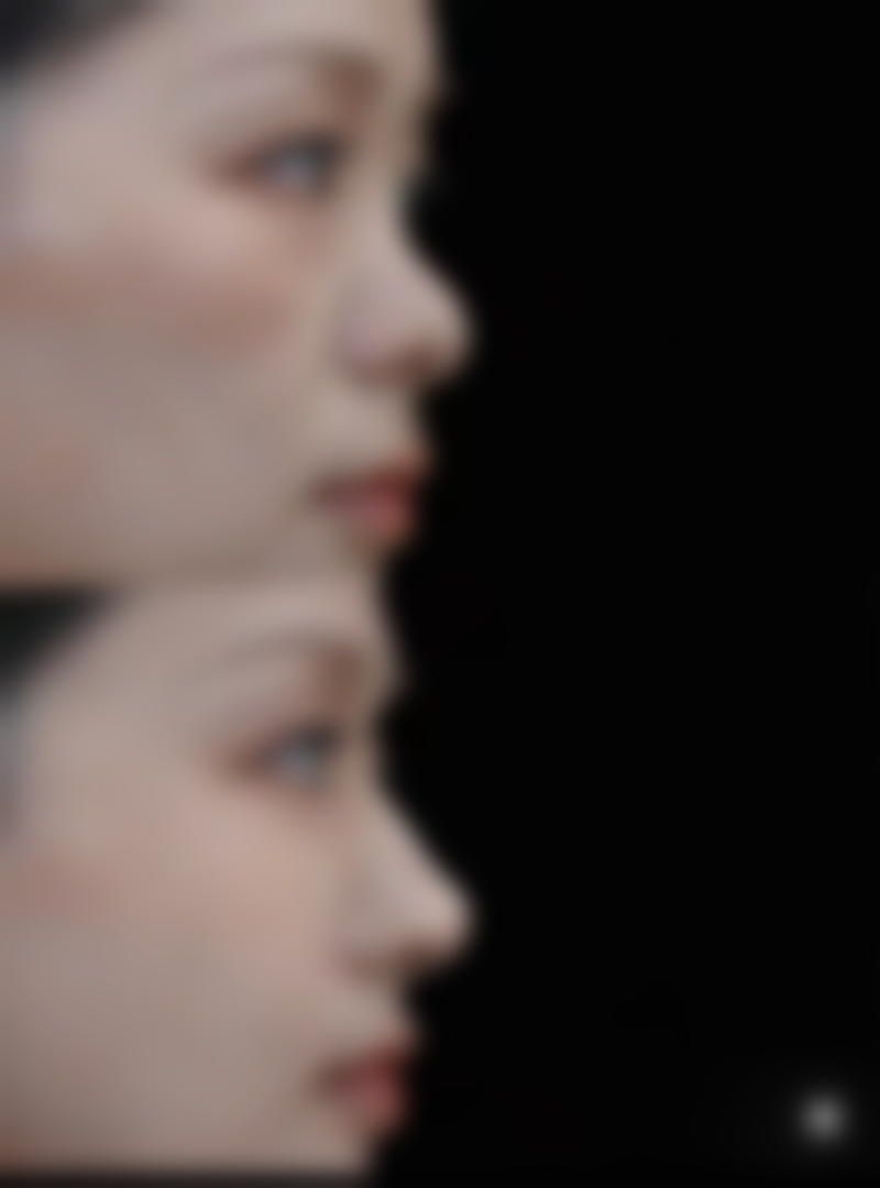 瘦脸针的注射间隔时间