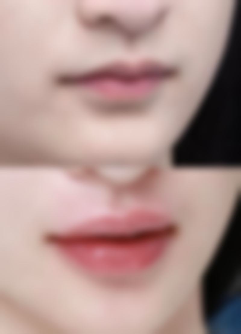 哪种除皱方法成效好、安心且维持时间长