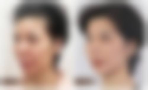 不同人群修复时间差异