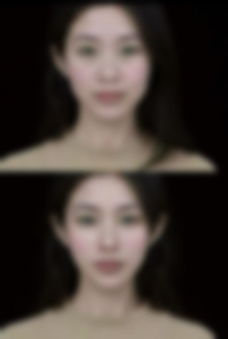 甲亢吃药可以打除皱吗？