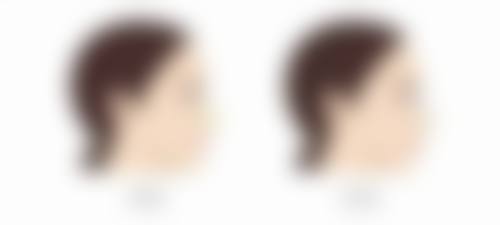 韩式微创紧缩术的危害