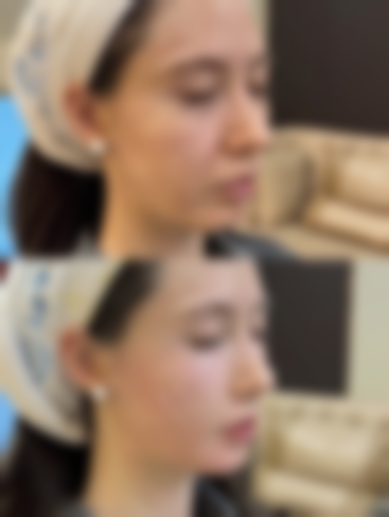 不同除皱产品价格及适用情况