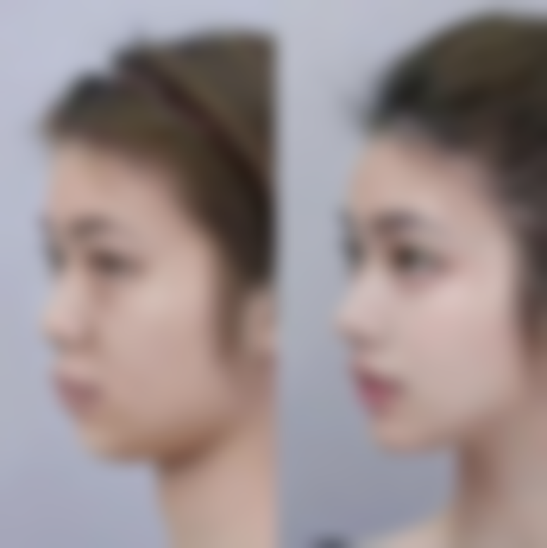 种植头发多久的脱落期？了解这3个关键时间点，让你轻松应对脱落期，植发效果显著提升！ 