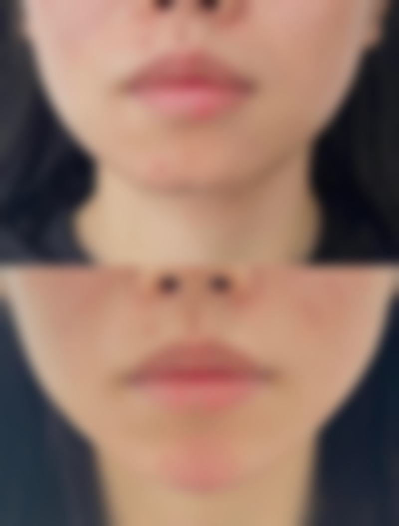 种植头发的危害和后遗症