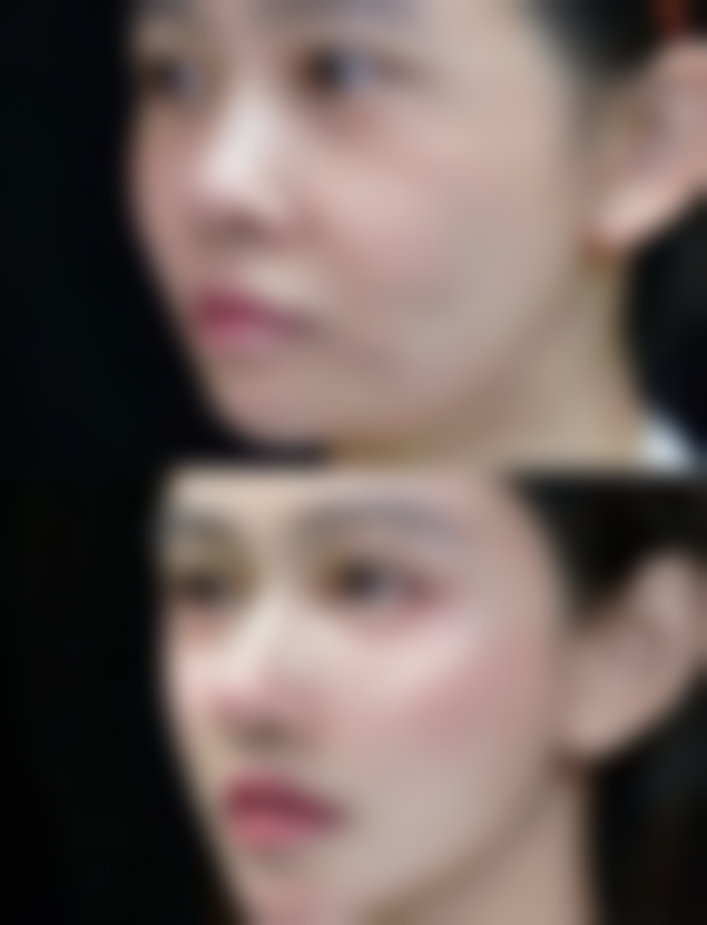 种植头发怎么收费