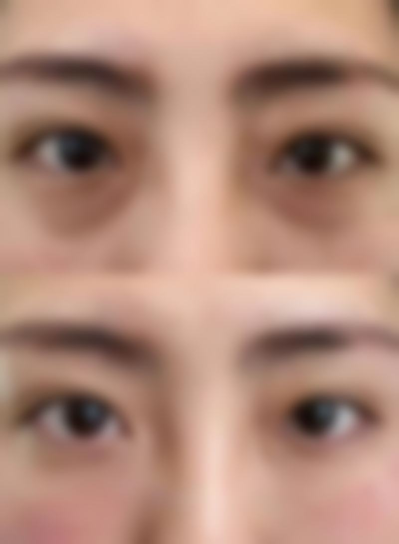 韩式微创紧缩术没成效是怎么回事