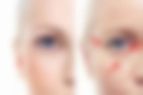 唇、腭裂及唇裂术后明显瘢痕的情况