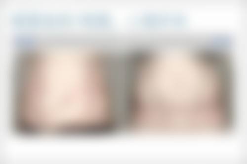 丰太阳穴的常见方法