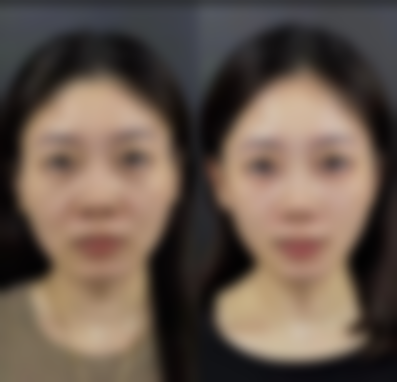 嘴角脸部下垂怎么办呢