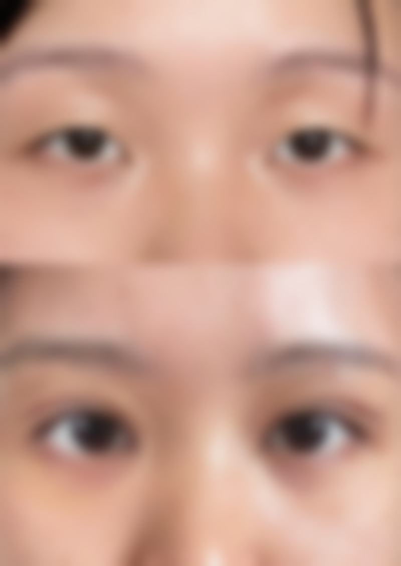 打完瘦脸针用忌口吗多久