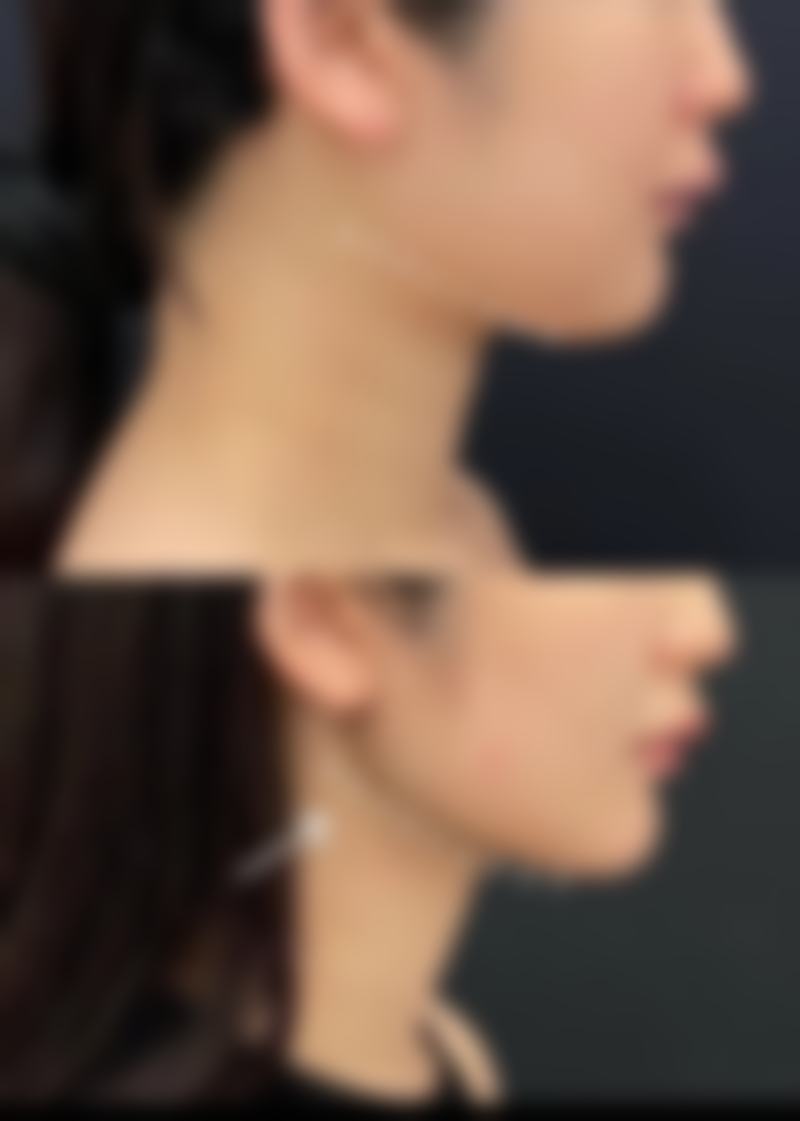 瘦脸针什么牌子的较好用