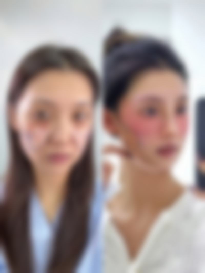 脸部下垂怎么修复