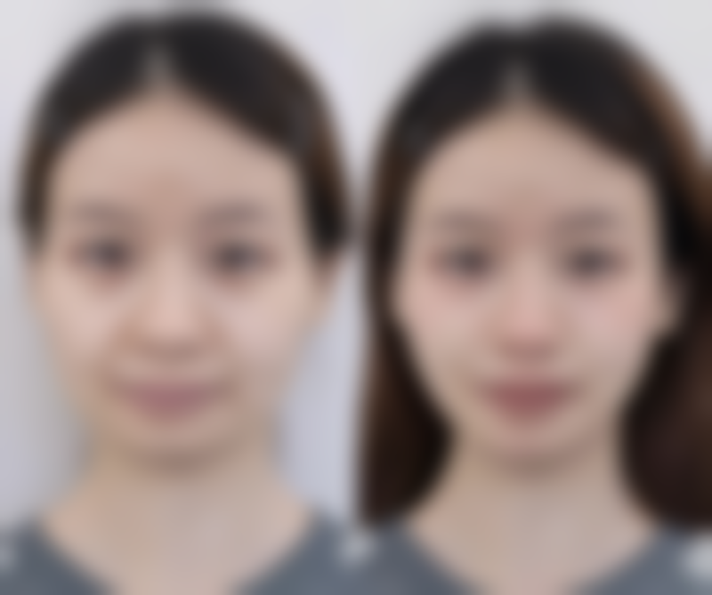 脸部下垂打瘦脸针有用吗