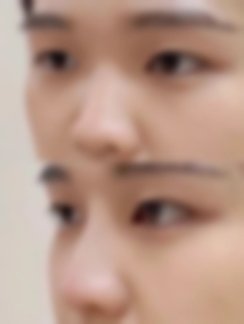 瘦脸针有多大成效，到底能瘦多少