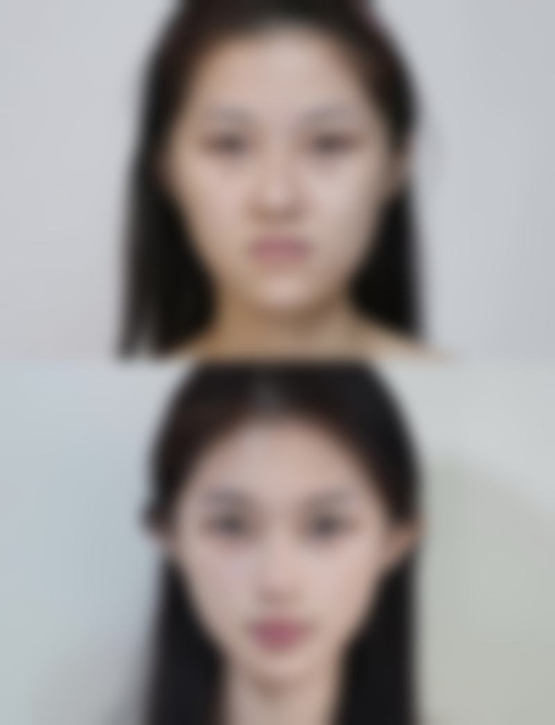 不知道怀孕了打了瘦脸针有影响吗