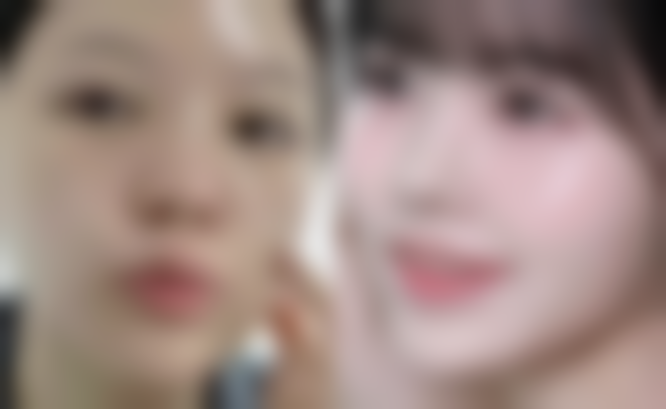 瘦脸针起作用吗