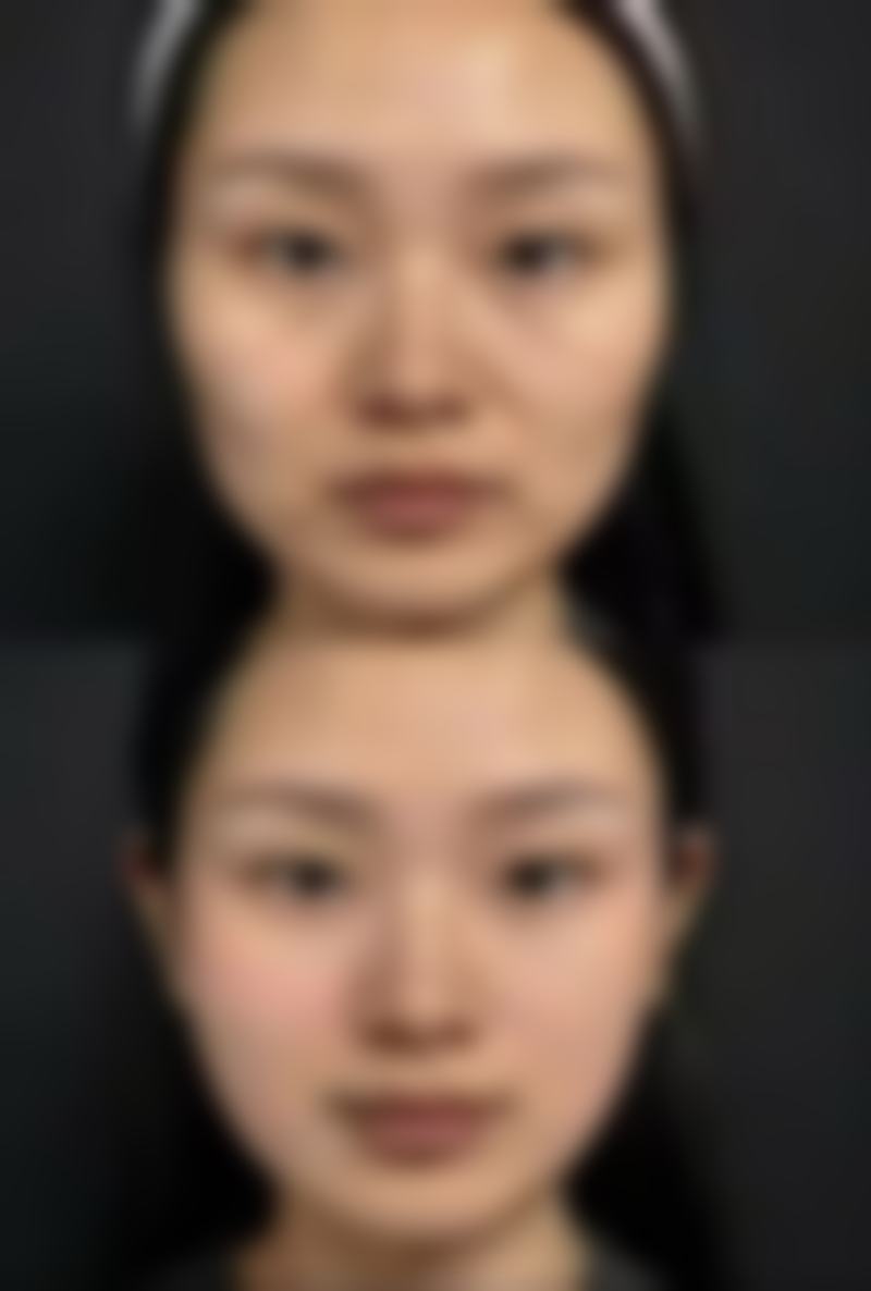 嘴有点歪能治疗吗多少钱