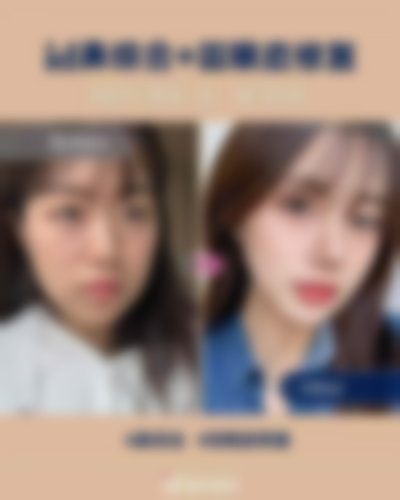 瘦脸针多久打一次可以维持恒久