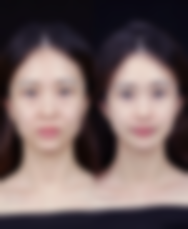 二、除皱针可以经常打吗