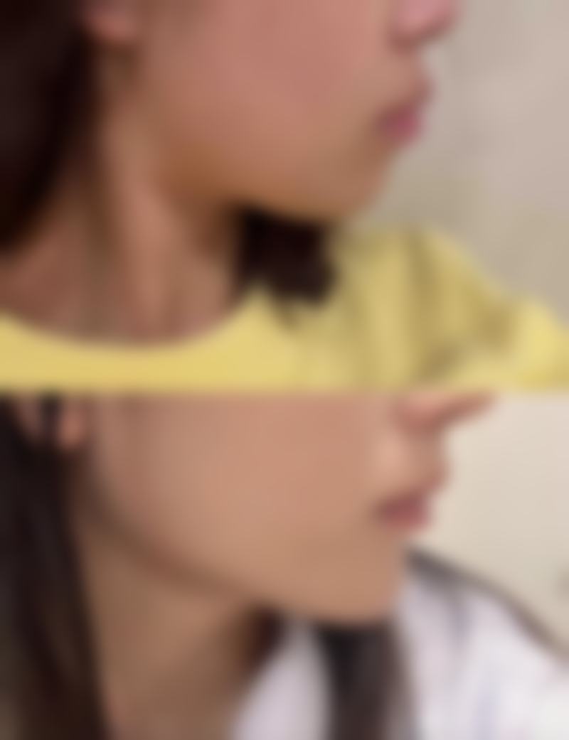 五、扎了除皱针变得好难看是怎么回事