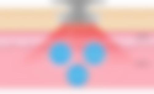 脱发青年们的“头顶大事” 能在植发机构“一植定终身”吗