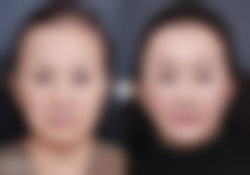 瘦脸针多久打一次可以维持恒久