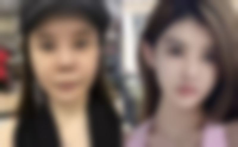 瘦脸针多久开始见成效