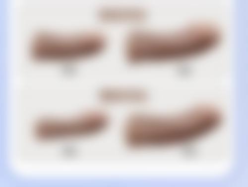 注射瘦脸针的注意事项