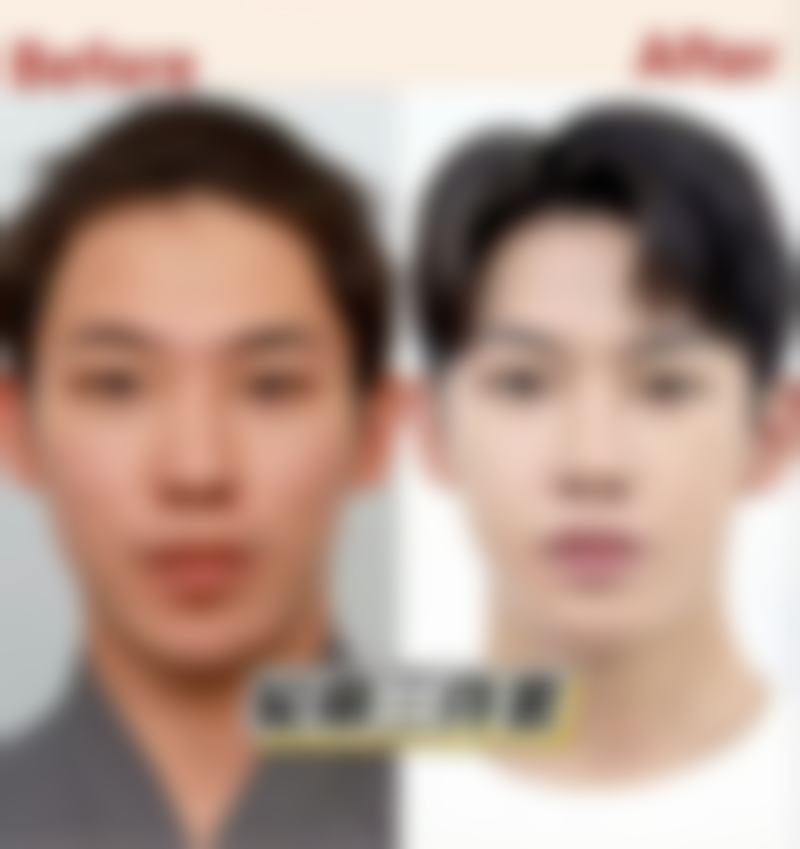 毛发种植术价钱是多少